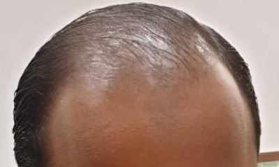Hair Fall Reasons