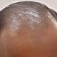 Hair Fall Reasons