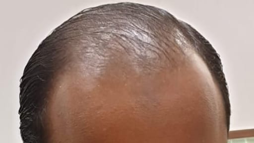 Hair Fall Reasons